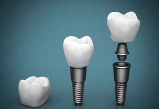 Dental implants